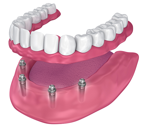 teeth implants in manchester